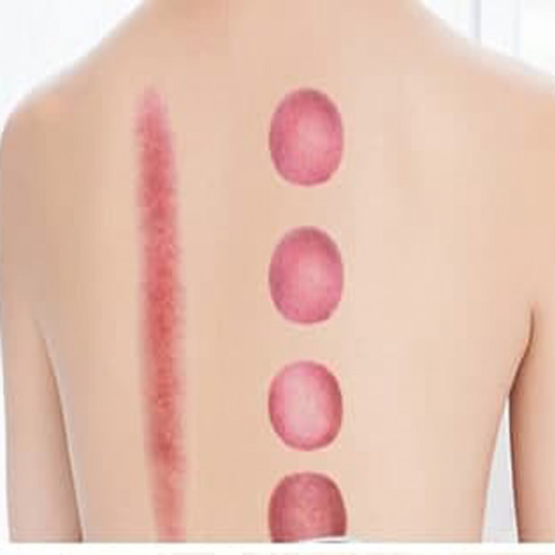 Vacuum cupping therapy and Scraping Body Guasha
